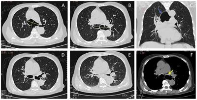 Tracheobronchomegaly associated with tracheobronchopathia osteochondroplastica: a case report